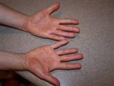 hand eczema after